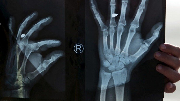 Increíble: se equivocaron y le implantaron el dedo del pie en su mano